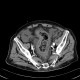 Pancolitis, colitis, severe: CT - Computed tomography